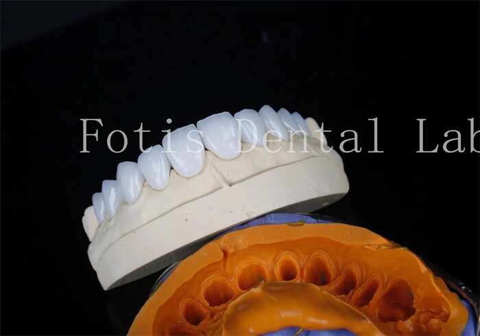 Veneers from China dental lab manufacturer - Fotis Dental Laboratory