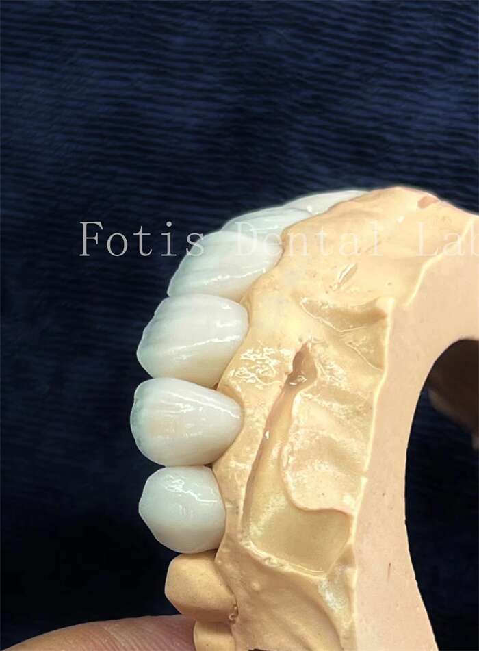 Veneers from China dental lab manufacturer - Fotis Dental Laboratory